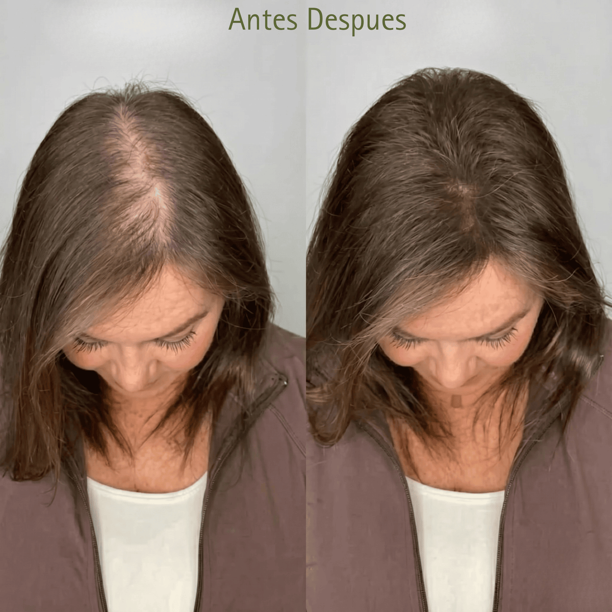 KIT ANTICAIDA | Recuperá tu Pelo: Frená la Caída y Estimulá el Crecimiento